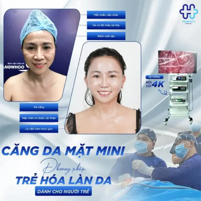 Căng da mặt mini