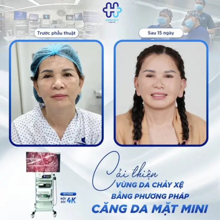 Căng da mặt mini