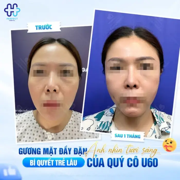 Căng da thái dương là gì? Căng da thái dương có tốt không?