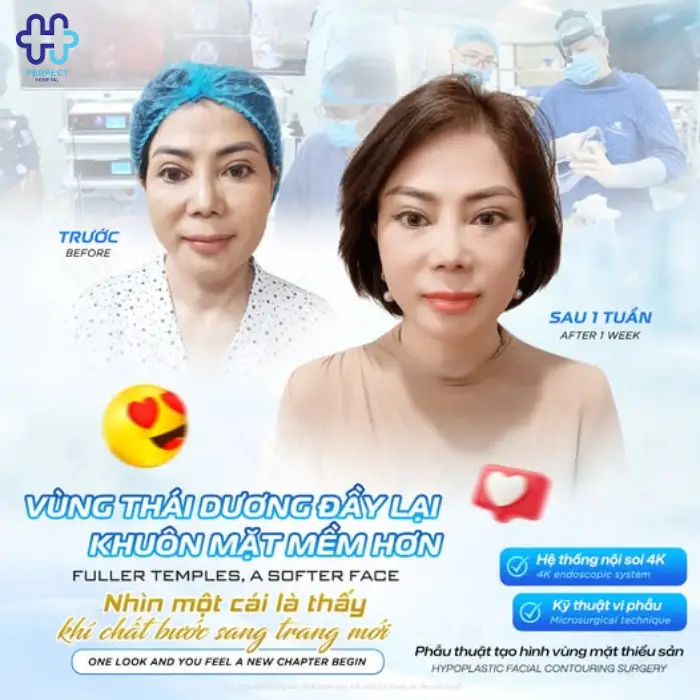 Căng da thái dương là gì? Căng da thái dương có tốt không?