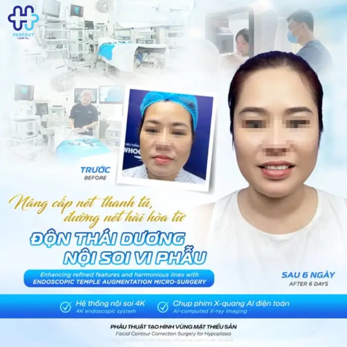 Căng da thái dương là gì? Căng da thái dương có tốt không?