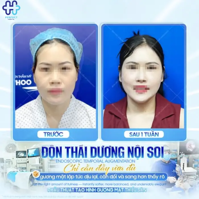 Căng da thái dương là gì? Căng da thái dương có tốt không?