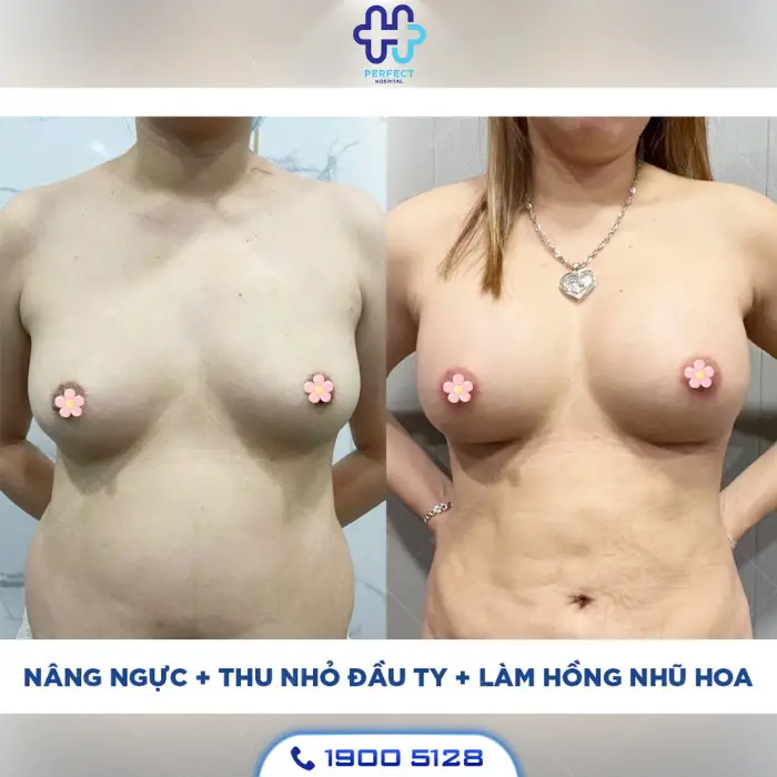 Làm hồng nhũ hoa là gì? Có nên phun hồng nhũ hoa không?