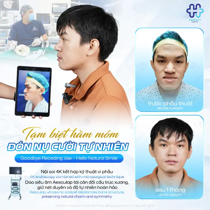 Phẫu thuật hàm móm là gì? Có an toàn không?