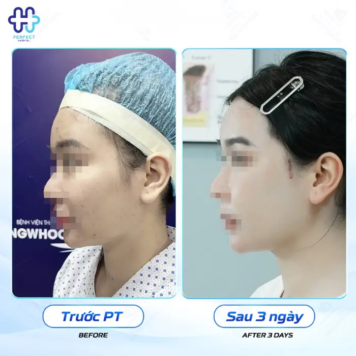 Nâng gò má là gì? Nâng gò má có an toàn không?