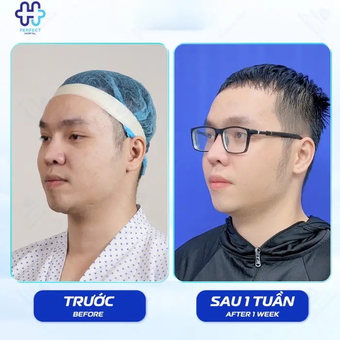 Nâng gò má là gì? Nâng gò má có an toàn không?