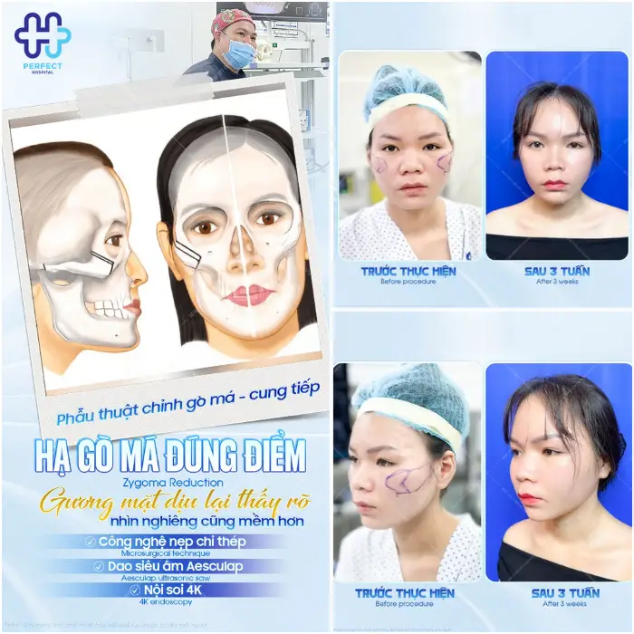 Nâng gò má là gì? Nâng gò má có an toàn không?