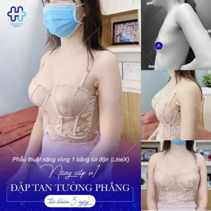 Nâng ngực line X là gì? Những điều bạn nên biết