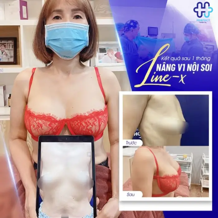 Nâng ngực line X là gì? Những điều bạn nên biết