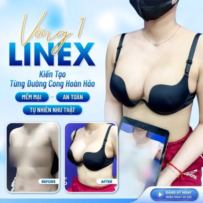Nâng ngực line X là gì? Những điều bạn nên biết