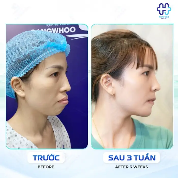 Phẫu thuật hàm móm là gì? Có an toàn không?