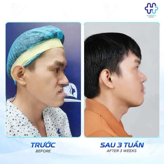 Phẫu thuật hàm móm là gì? Có an toàn không?