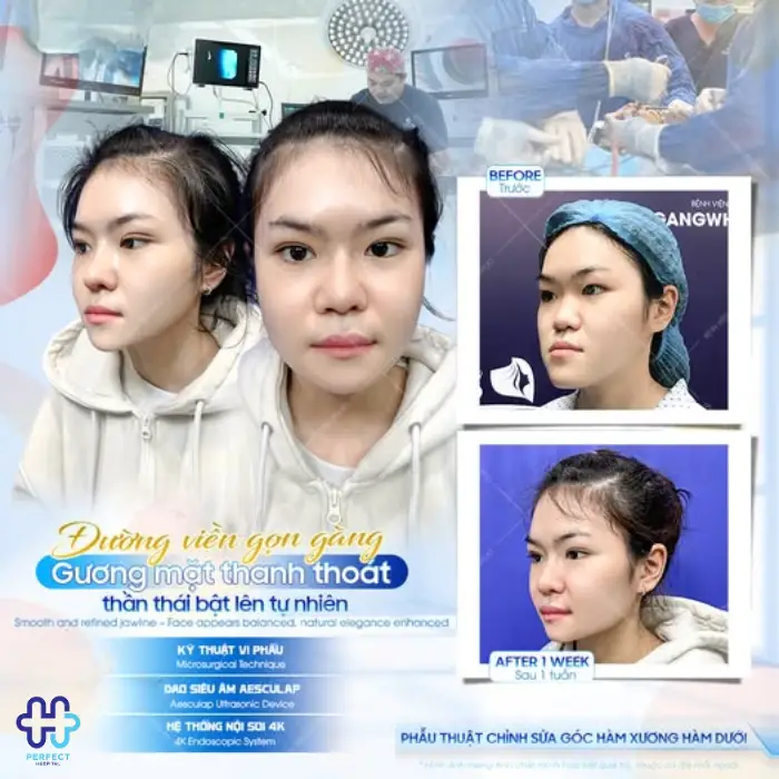 Phẫu thuật hàm móm là gì? Có an toàn không?