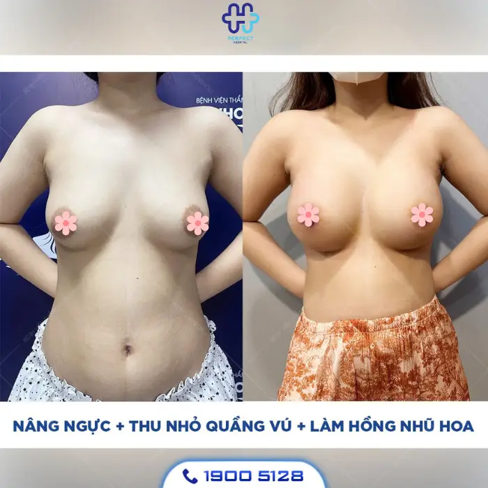 Thu gọn quầng vú: Ưu điểm và quy trình thực hiện