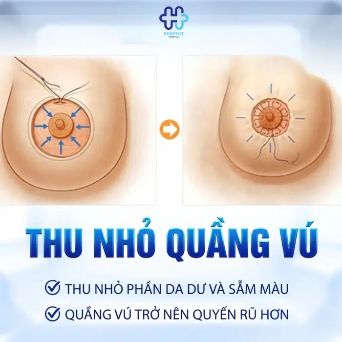 Thu gọn quầng vú: Ưu điểm và quy trình thực hiện