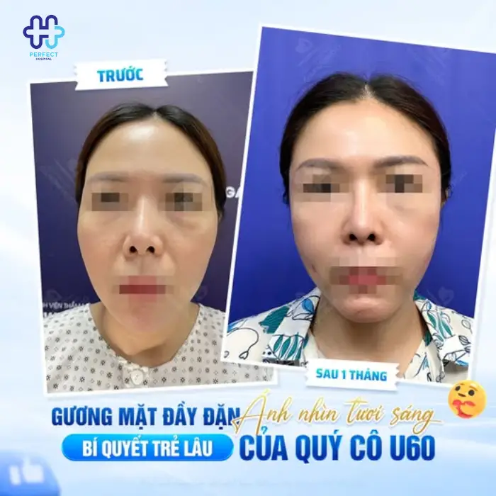 Cấy mỡ làm đầy vùng mặt: Lợi ích và quy trình thực hiện