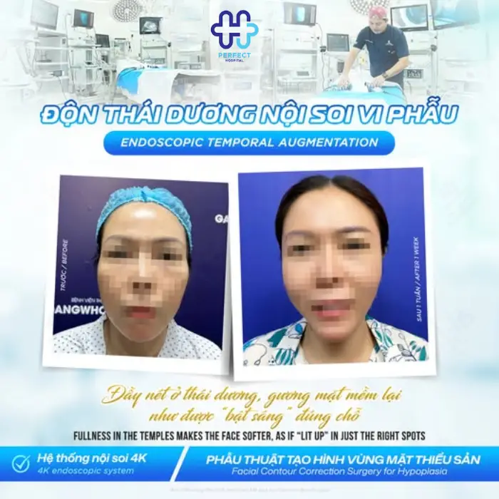 Cấy mỡ làm đầy vùng mặt: Lợi ích và quy trình thực hiện