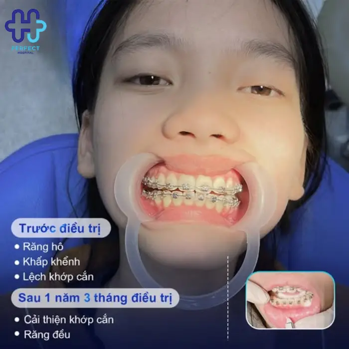 Chỉnh nha niềng răng