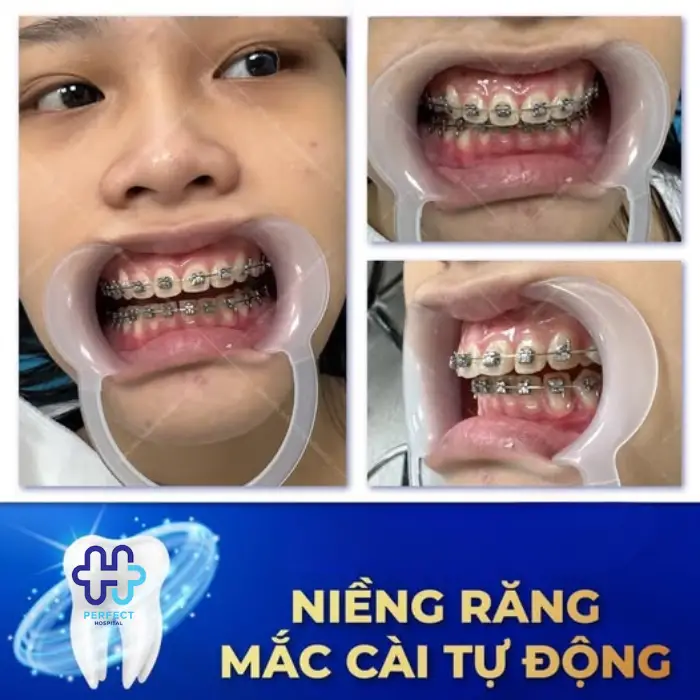 Chỉnh nha niềng răng