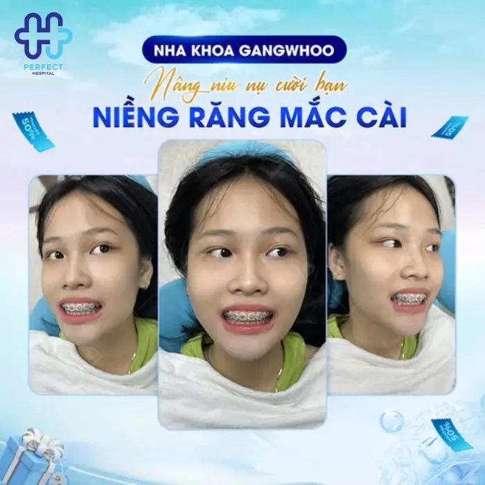 Chỉnh nha niềng răng