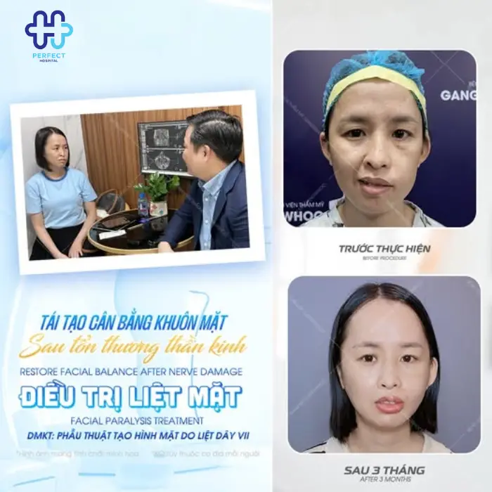 Điều trị liệt mặt (Liệt dây thần kinh số 7)