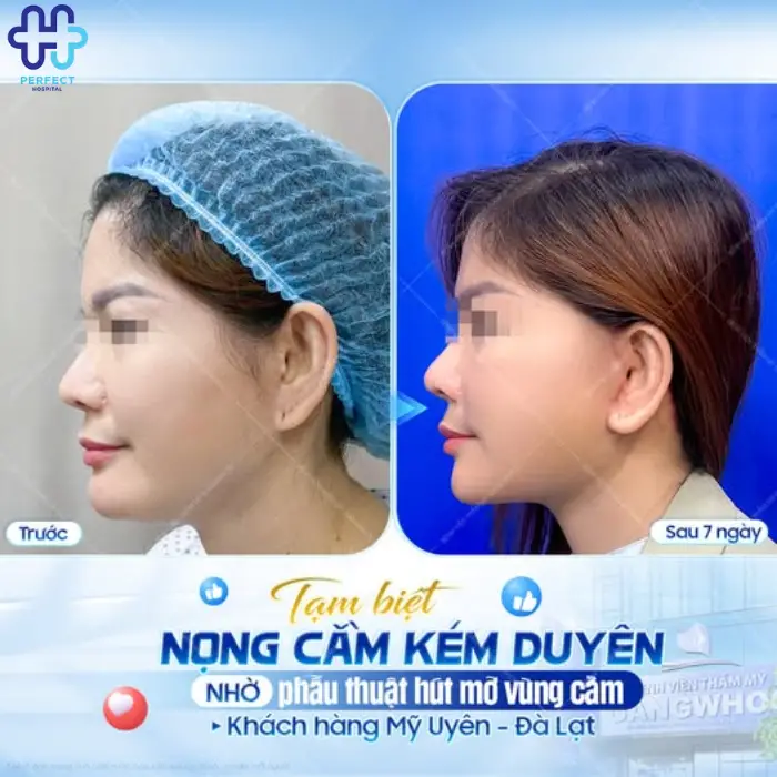 Lấy mỡ nọng cằm là gì? Những ai nên giảm mỡ nọng cằm?