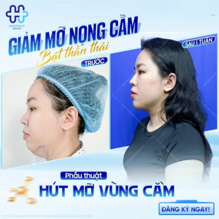 Lấy mỡ nọng cằm là gì? Những ai nên giảm mỡ nọng cằm?
