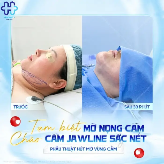 Lấy mỡ nọng cằm là gì? Những ai nên giảm mỡ nọng cằm?