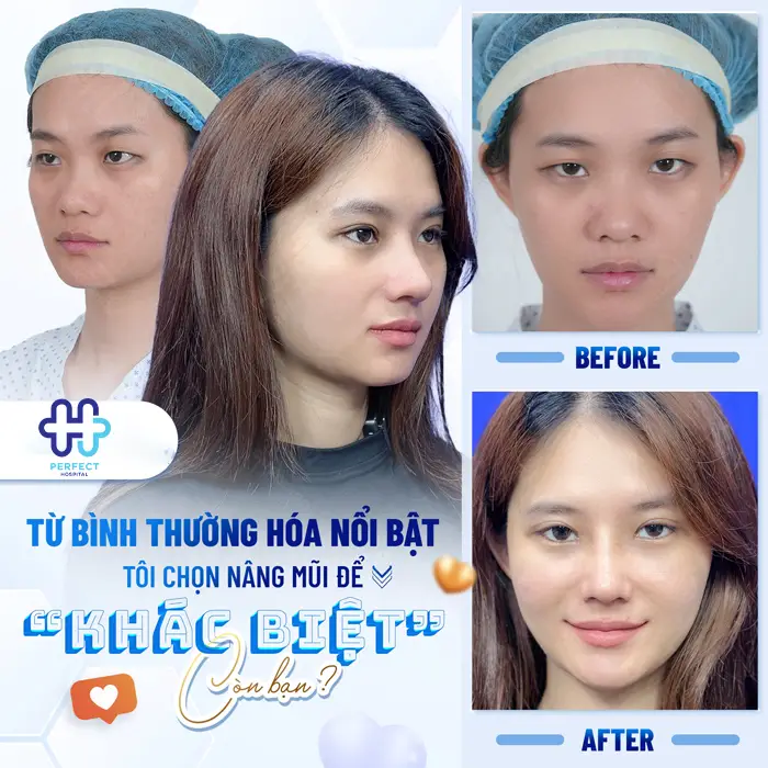 Nâng Mũi Cao Tây Là Gì? Có Nên Nâng Mũi Cao Như Tây Không?