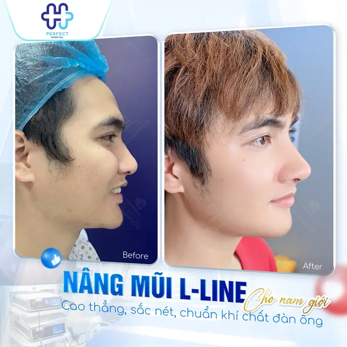 Nâng Mũi Cao Tây Là Gì? Có Nên Nâng Mũi Cao Như Tây Không?