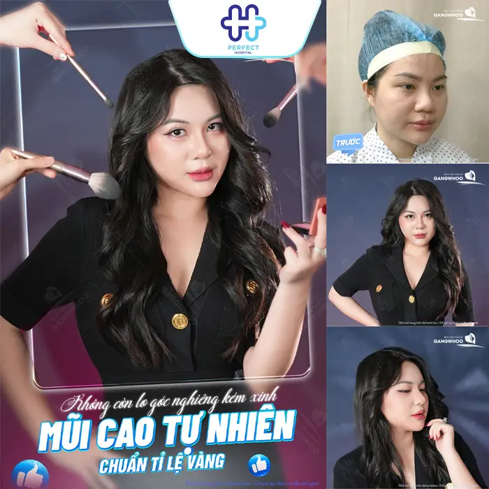 Nâng Mũi Cao Tây Là Gì? Có Nên Nâng Mũi Cao Như Tây Không?