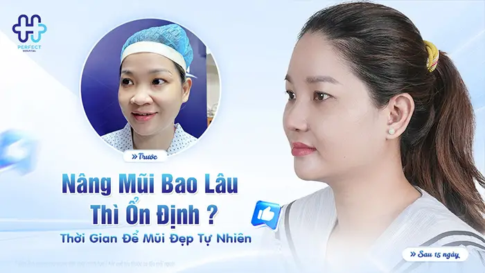 Nâng Mũi Bao Lâu Thì Ổn Định? Thời Gian Để Mũi Đẹp Tự Nhiên