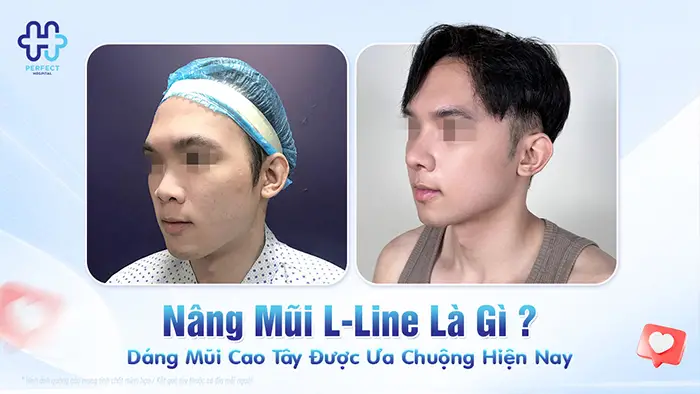 Nâng Mũi L Line Là Gì? Dáng Mũi Cao Tây Được Ưa Chuộng Hiện Nay