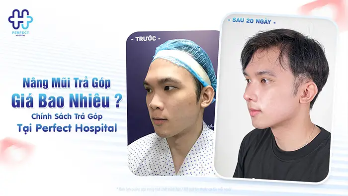 Nâng Mũi Trả Góp Giá Bao Nhiêu? Chính Sách Trả Góp Tại Perfect Hospital