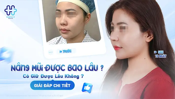 Nâng Mũi Được Bao Lâu? Có Giữ Được Lâu Không? Giải Đáp Chi Tiết