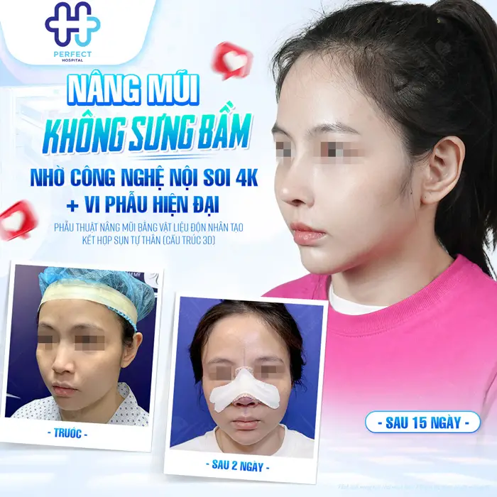 Có Nên Nâng Mũi Không? Góc Nhìn Chuyên Môn Trước Khi Quyết Định