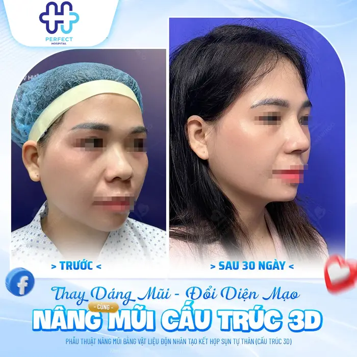 Có Nên Nâng Mũi Không? Góc Nhìn Chuyên Môn Trước Khi Quyết Định