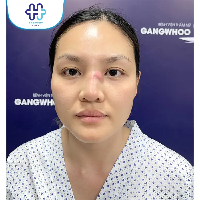 Dấu Hiệu Nâng Mũi Bị Viêm Và Cách Xử Lý An Toàn Đúng Cách