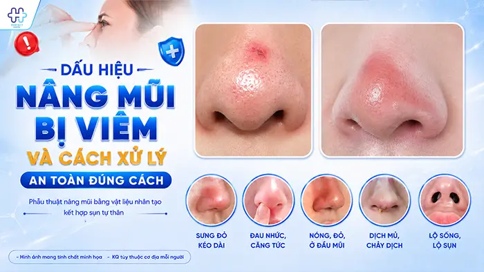 Dấu Hiệu Nâng Mũi Bị Viêm Và Cách Xử Lý An Toàn Đúng Cách