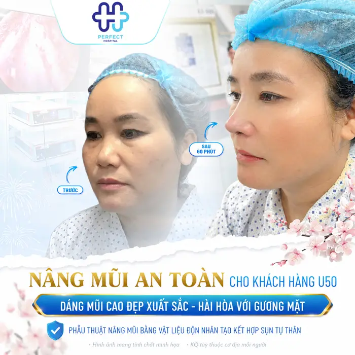 Hậu Quả Của Nâng Mũi Khi Về Già Có Đáng Lo Không? Góc Nhìn Chuyên Môn