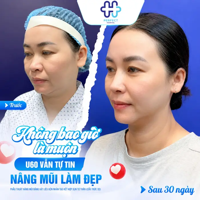Hậu Quả Của Nâng Mũi Khi Về Già Có Đáng Lo Không? Góc Nhìn Chuyên Môn