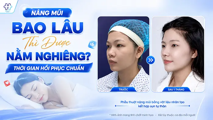 Nâng Mũi Bao Lâu Thì Được Nằm Nghiêng? Thời Gian Hồi Phục Chuẩn