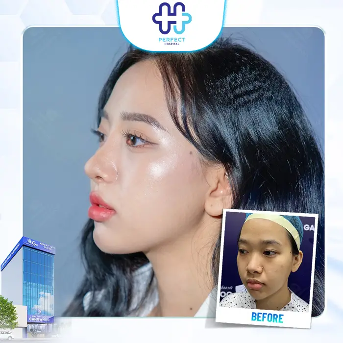 Nâng Mũi Bao Lâu Thì Đầu Mũi Hết To? Thời Gian Để Mũi Thon Gọn Tự Nhiên