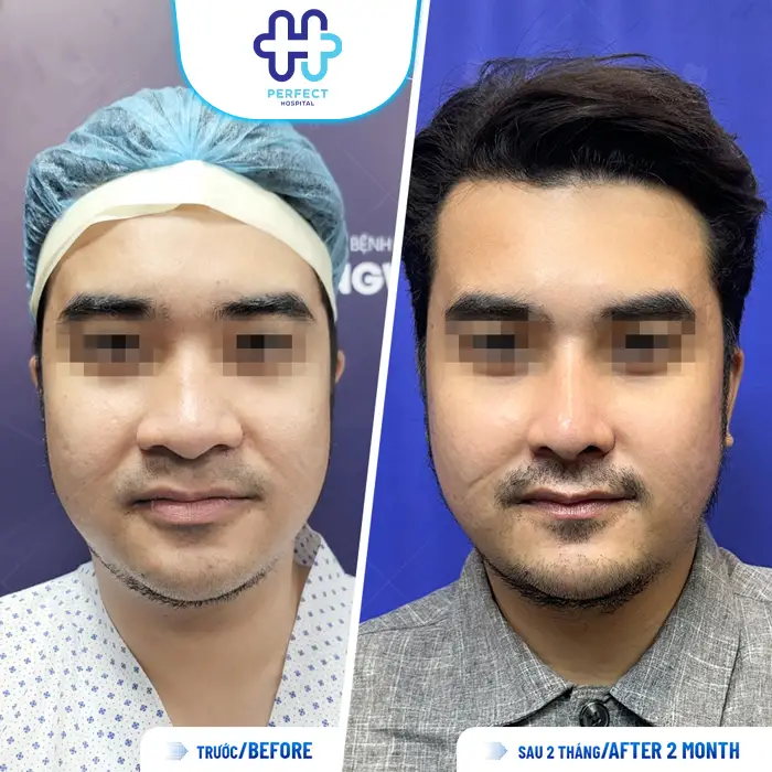 Nâng Mũi Bao Lâu Thì Đầu Mũi Hết To? Thời Gian Để Mũi Thon Gọn Tự Nhiên