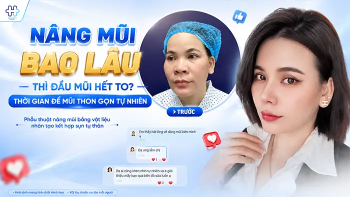 Nâng Mũi Bao Lâu Thì Đầu Mũi Hết To? Thời Gian Để Mũi Thon Gọn Tự Nhiên