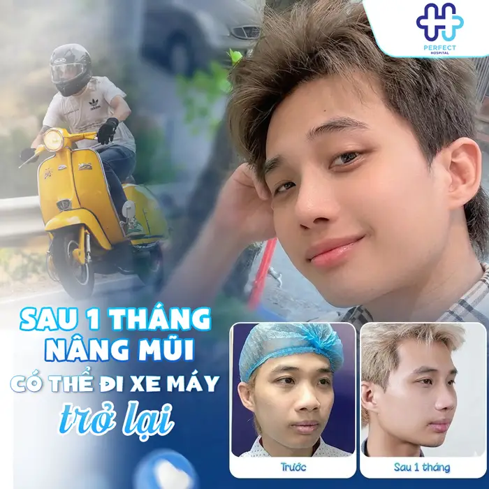Nâng Mũi Bao Lâu Thì Đi Xe Máy Được? Thời Gian An Toàn Sau Phẫu Thuật