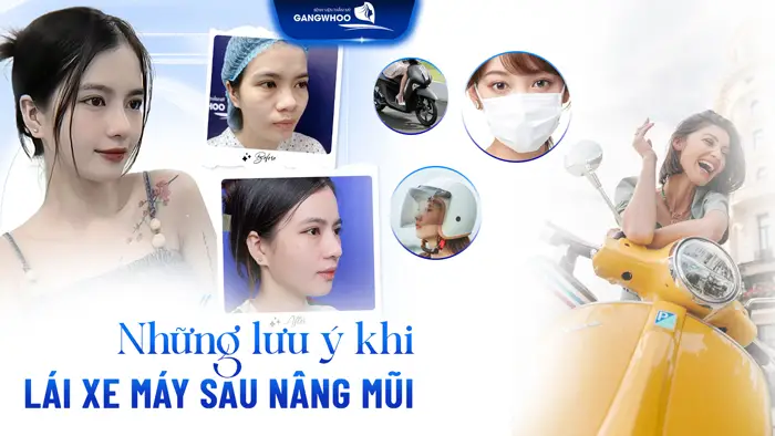 Nâng Mũi Bao Lâu Thì Đi Xe Máy Được? Thời Gian An Toàn Sau Phẫu Thuật
