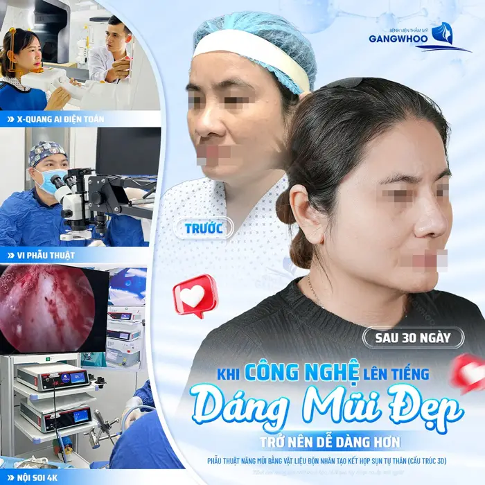 Nâng Mũi Bao Lâu Thì Đi Xe Máy Được? Thời Gian An Toàn Sau Phẫu Thuật