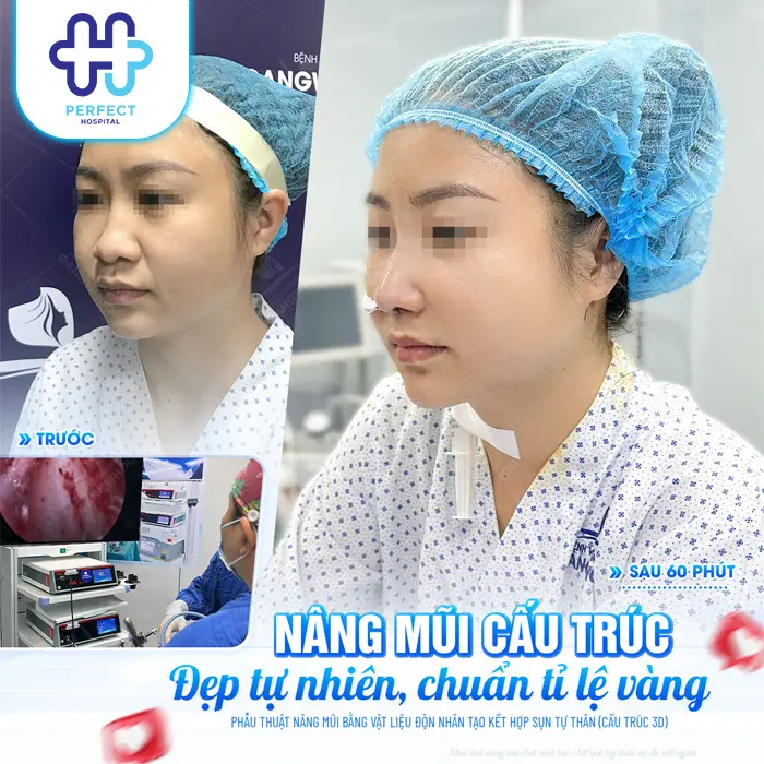 Nâng Mũi Bao Lâu Thì Được Nằm Nghiêng? Thời Gian Hồi Phục Chuẩn