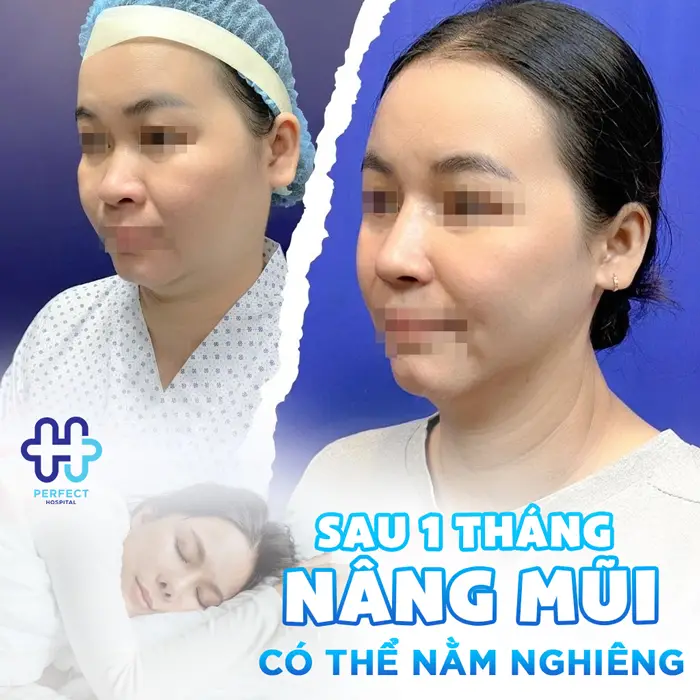Nâng Mũi Bao Lâu Thì Được Nằm Nghiêng? Thời Gian Hồi Phục Chuẩn